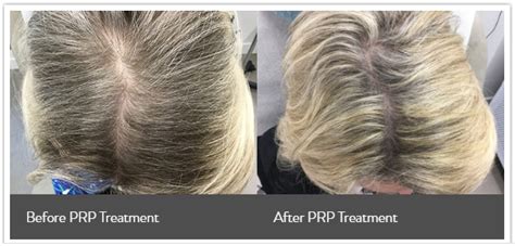 Womens Hair Loss Treatment Nyc Goldenberg Dermatology