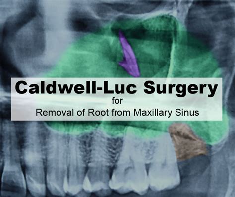 Caldwell Luc Surgery