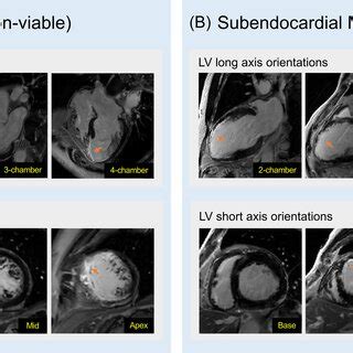 Late Gadolinium Enhancement Lge Cmr For Myocardial Viability Lgecmr