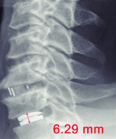 Post Operative Lateral Plain Radiograph Shows Well Inserted Artificial