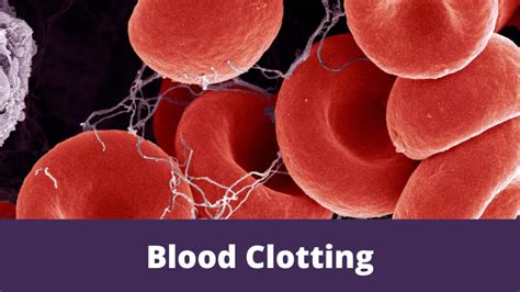 Blood Clot Symptoms Deep Vein Thrombosis And Pulmonary 52 Off