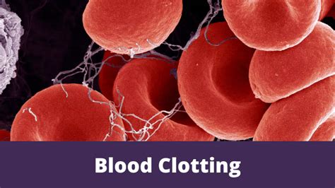 Blood Clot Symptoms Deep Vein Thrombosis And Pulmonary 52 OFF