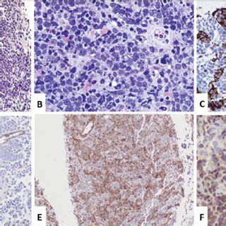 A Low Power View Of H E Stained Section Of Abdominal Mass Biopsy