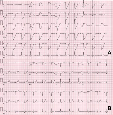 Vasospastic Arrest A Heart Stopping Case Of Prinzmetal Angina Jacc