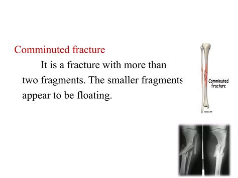 fracture pptx