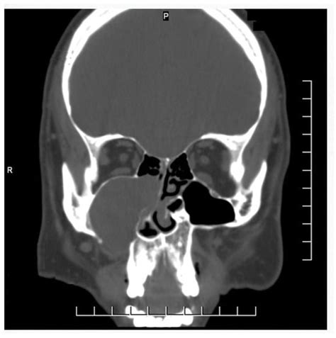 Medicina Free Full Text Prelacrimal Recess Approach In Unilateral Maxillary Sinus Lesions