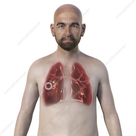 Cavernous Tuberculosis Illustration Stock Image F038 6452 Science Photo Library