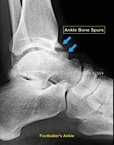 Osseous Equinus Footballers Ankle Integrative Foot And Ankle Centers