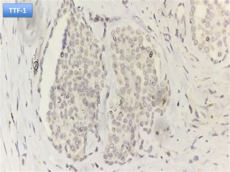 07 histology, cytology and biomarkers in pleural diseases | PPT