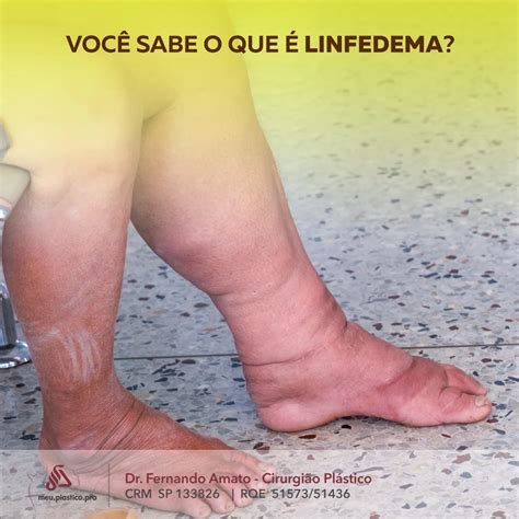 O Que Todas Essas Mulheres Tem Em Comum Tudo Sobre Lipedema