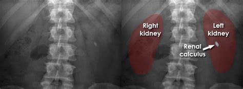 Kidney Stone Xray