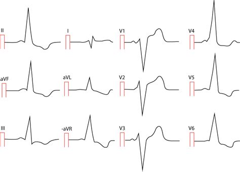 Preexcitation - EKG.nu