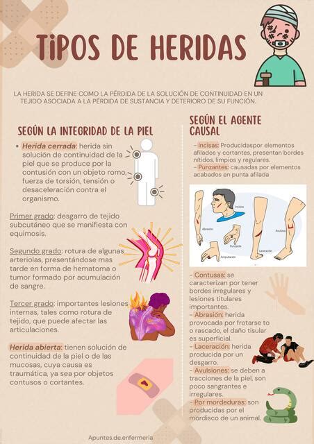 Infografia Sobre Los Distintos Tipos De Heridas Herida Lesion Causada Nbkomputer