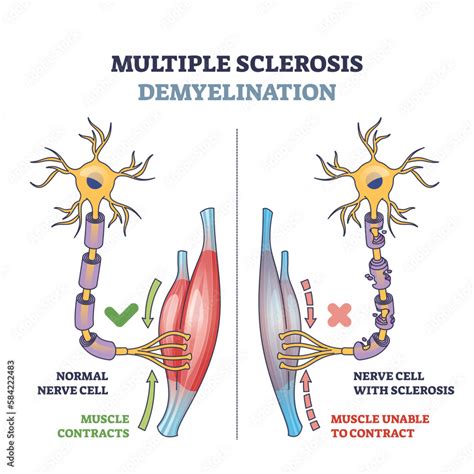 Multiple Sclerosis Demyelination Compared With Medical Healthy Nerves