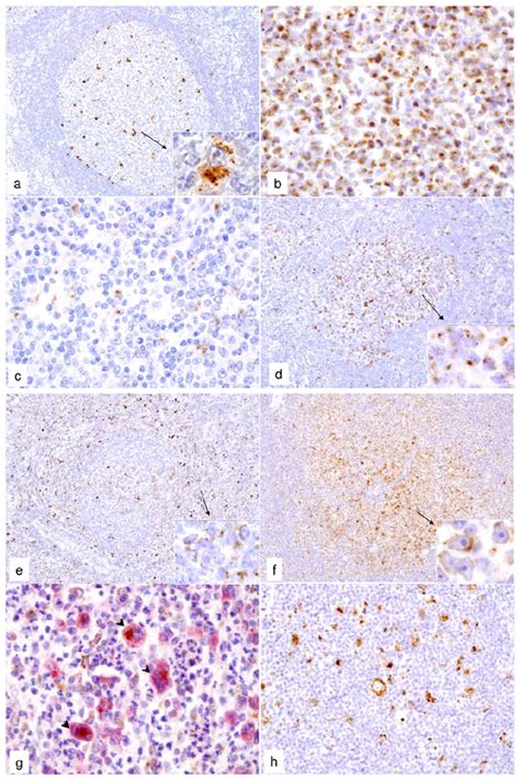 Il4i1 Protein Expression In Reactive Lymphoid Tissue And Lymphoid