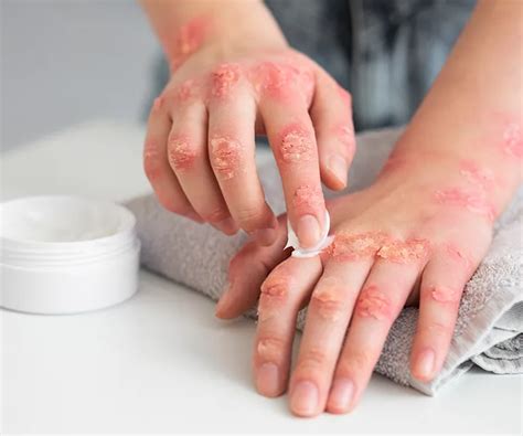 Atopik Dermatit Atopik Dermatit Nedir