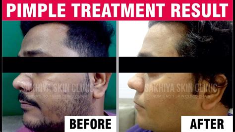 Say Goodbye To Acne Pimple Treatment Testimonials Sakhiya Skin