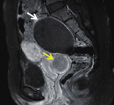 Sagittal Pelvic Magnetic Resonance Imaging Showed About Cm Sized