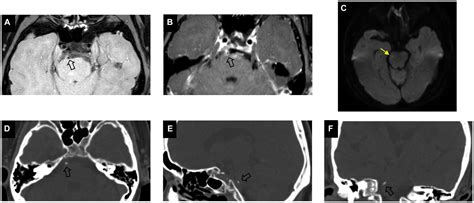 Frontiers Ct Texture Analysis Of Vertebrobasilar Artery Calcification