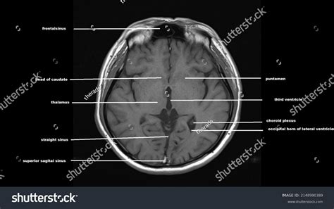 Normal Brain Anatomy Axial T1weighted Mri Stock Photo 2148990389