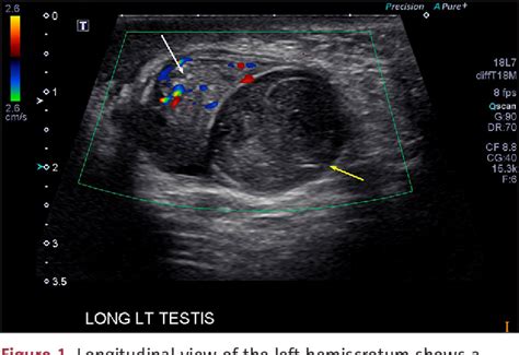 Figure 1 From Paratesticular Dermoid Cyst Mimicking A Torsed