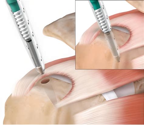 Cirurgia Do Ombro E Cotovelo Dr Vagner Messias Tratamento De Ombro