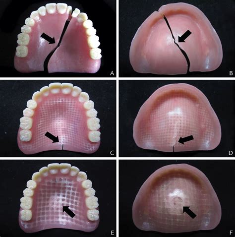 Effects Of Glass Fiber Mesh With Different Fiber Content And Structures