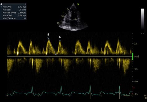 Early Echocardiographic Predictors For Atrial Fibrillation Propensity The Left Atrium Oracle