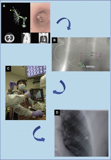 Improved Visualization Of Virtual Assisted Lung Mapping By Indocyanine