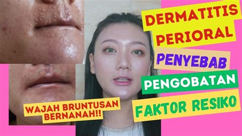 Mengenal Penyebab Dermatitis Ketahui Gejala Dan Pencegahannya Halaman