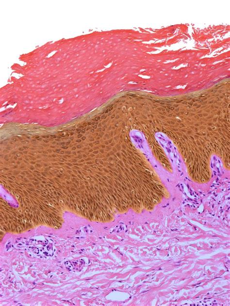 Squamous Hyperplasia 1 By Steve Gschmeissner