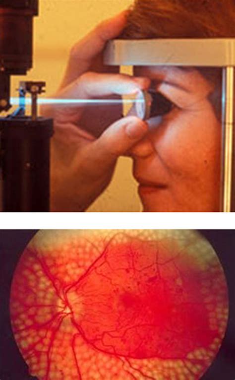 Impactos de láser en retinopatia diabética