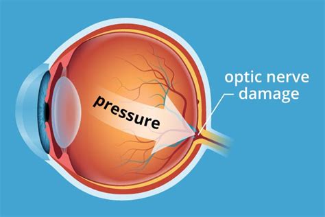 Glaucoma - Dove Health