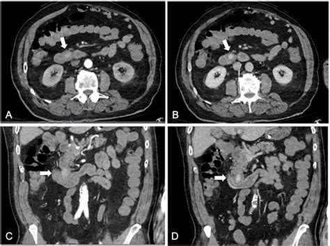 Submucosal Duodenal Artery Pseudoaneurysm Causing Massive