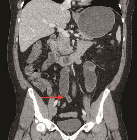 Cirugía laparoscópica monopuerto en obstrucción intestinal Experiencia