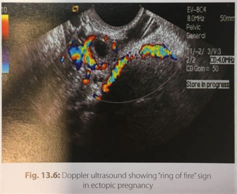Ectopic Pregnancy Flashcards Quizlet