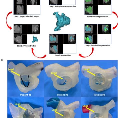 Preoperative 3d Reconstruction And 3d Printed Models Of All 6 Patients Download Scientific