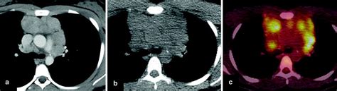 Of The Pediatric Thymus And Thymic Disorders Radiology Key