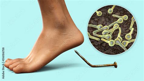 Transmission Of Tetanus Bacteria By Contaminated Wounds 3D Conceptual