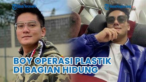 Boy William Ternyata Jalani Operasi Plastik Karena Hidung Bengkok Dan