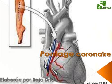 Pontage Coronaire Pdf Etude Az