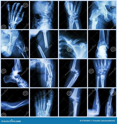 Fractura De Hueso Múltiple De La Radiografía De La Colección Imagen De