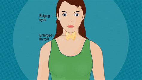 What To Know About Thyroid Eye Disease Graves Ophthalmopathy Wecare