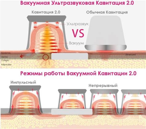 Кавитация. Отзывы до и после, фото тела, что это такое ...