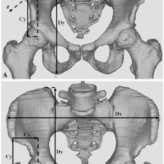 A B A Anteroposterior And B Lateral D Views Of The Pelvis Show