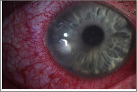 Bcla Clear Contact Lens Complications Contact Lens And Anterior Eye