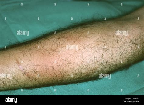 Compartment syndrome fasciotomy surgery hi-res stock photography and images - Alamy