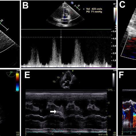 Echocardiography Showing Svsd Pfo And Right To Left Shunt Download