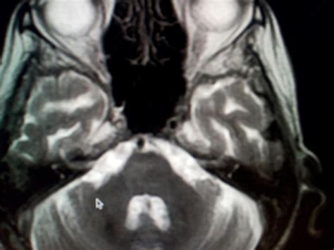 Radiodiagnóstico RMN Cerebral ECV Isquémico Mapa ADC