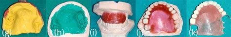 Prosthetic Rehabilitation Of Post Covid Mucormycosis Of Maxilla With